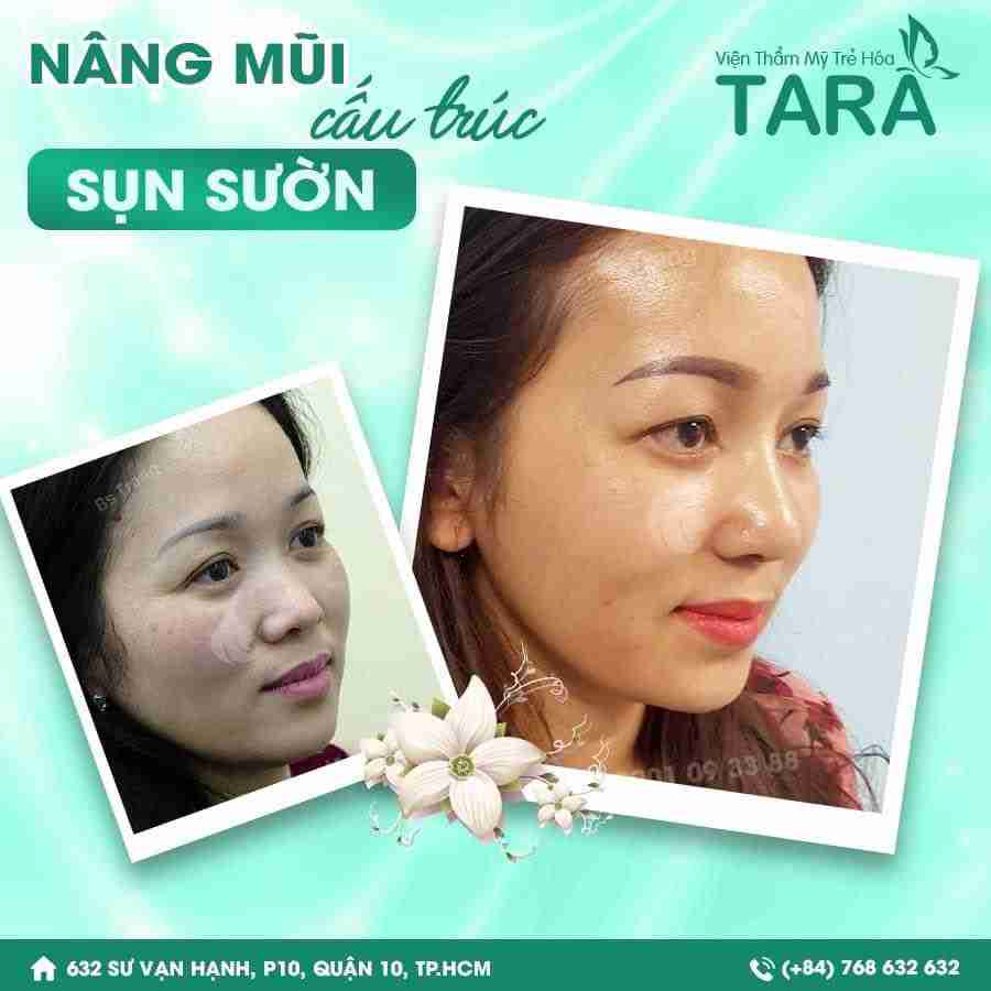 Nâng mũi sụn sườn giá bao nhiêu