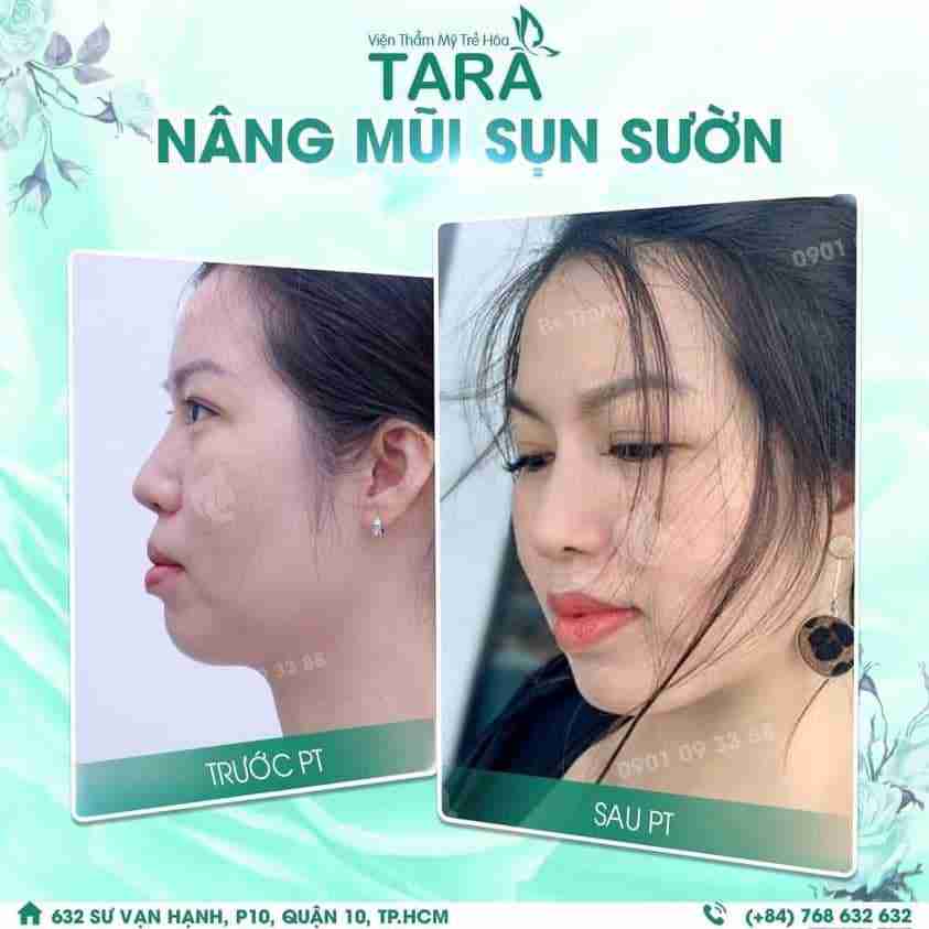 Sụn sườn được lấy từ đâu để nâng mũi