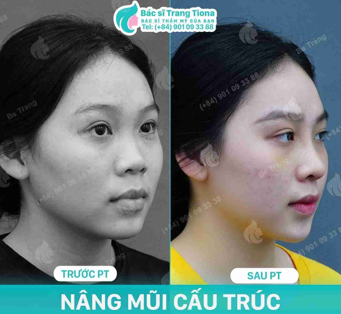 Review nâng mũi bác sĩ Trang
