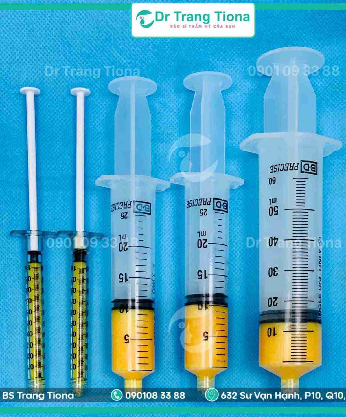 Cấy mỡ mặt Babyface có bền không?