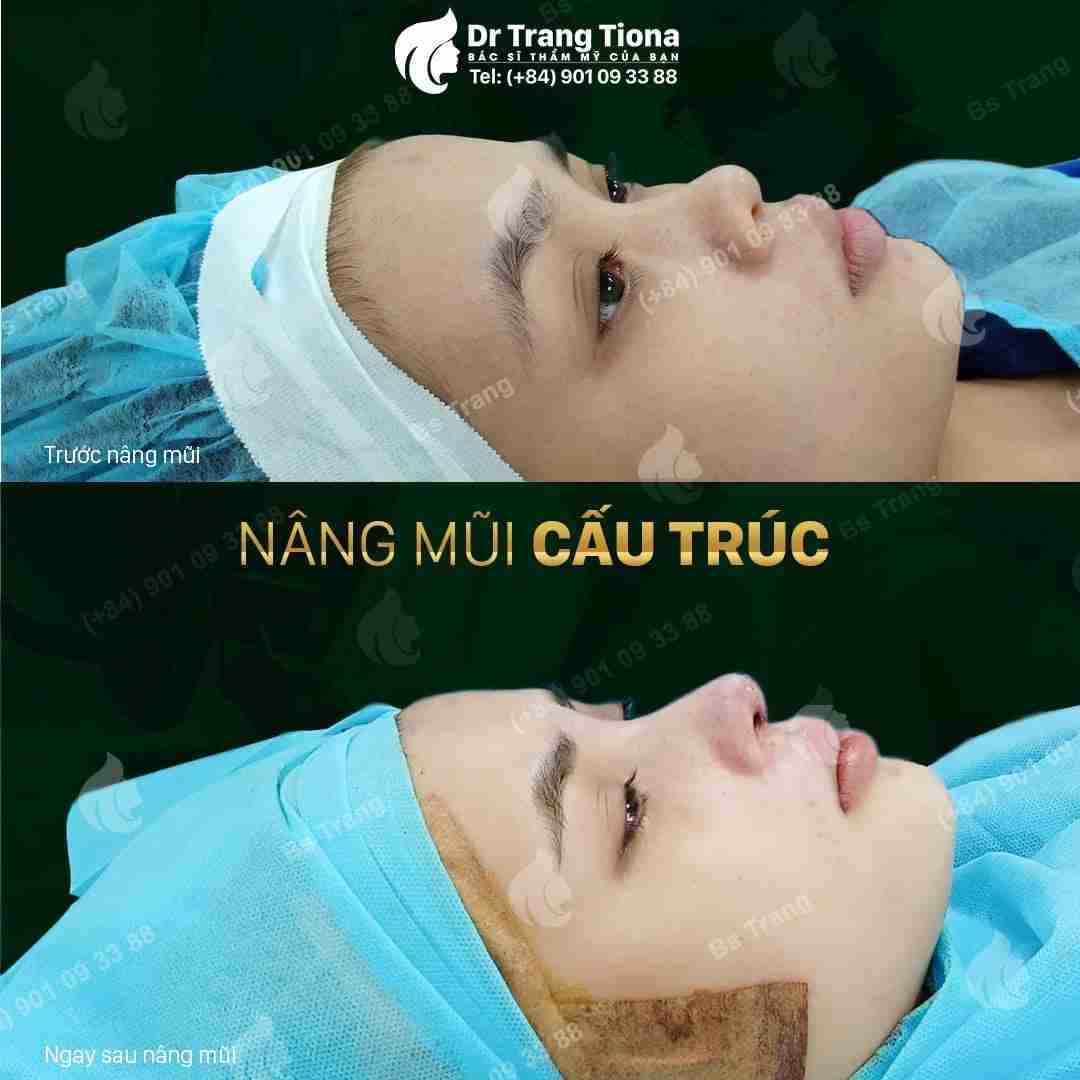 Giải đáp từ A-Z về nâng mũi Sline và lưu ý quan trọng