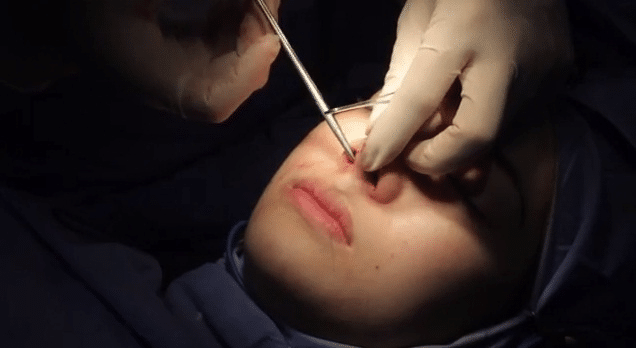 Nâng mũi xong tháo sụn ra có ảnh hưởng gì không?