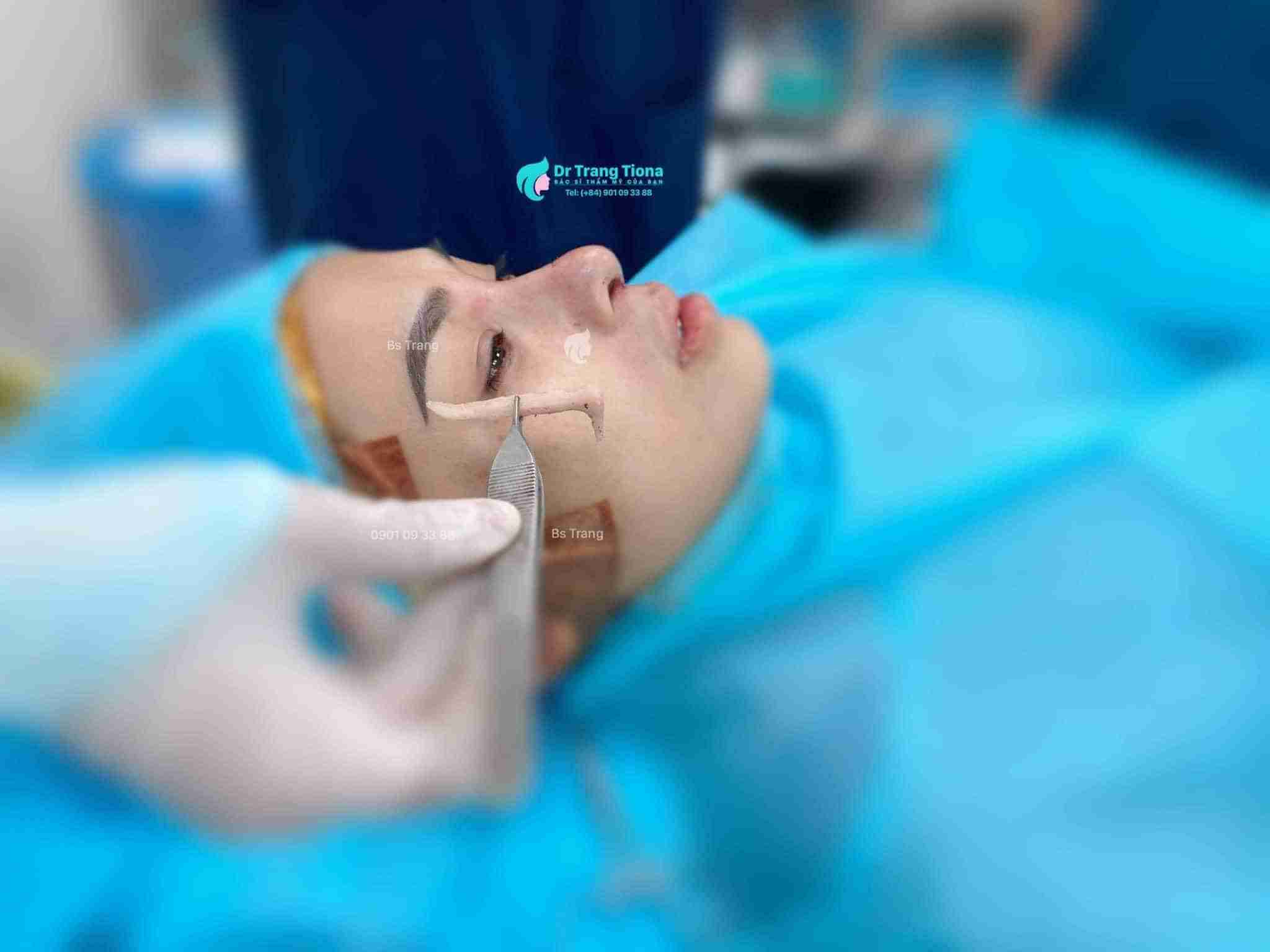 5 điều quan trọng cần biết trước khi tháo sụn nâng mũi