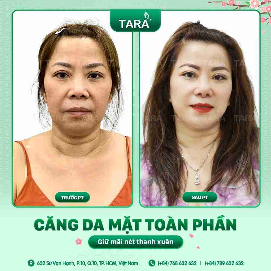 căng da thái dương