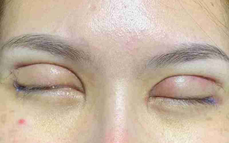 Các biến chứng thường gặp sau khi cắt mí mắt