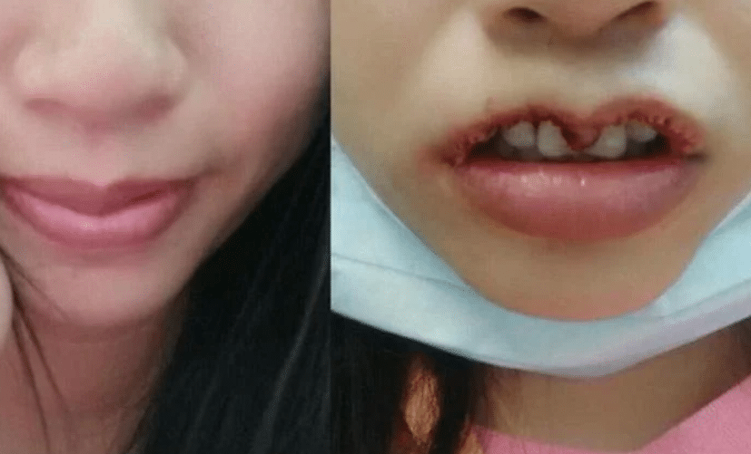 Cảnh báo biến chứng cắt môi trái tim
