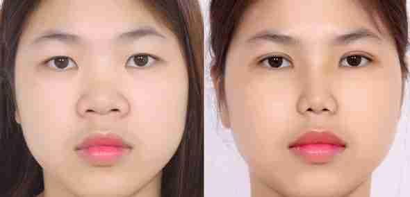  Cắt mí mắt bao lâu thì nhìn tự nhiên nhất?