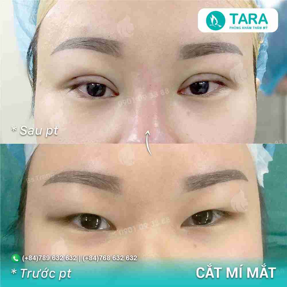 Review chi tiết cắt mắt hai mí bền đẹp tự nhiên 