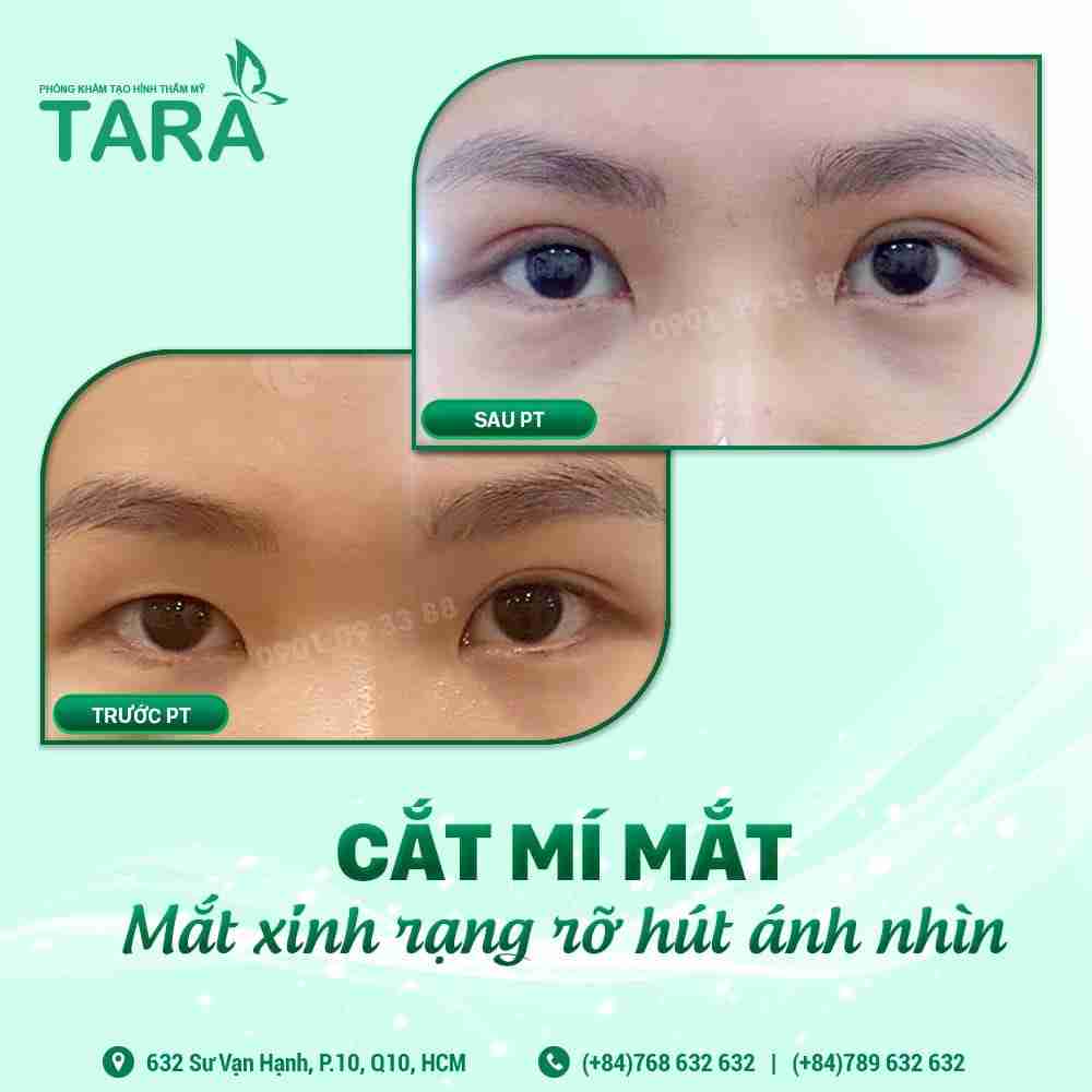 Cắt mí bao lâu thì được rửa mặt bình thường?