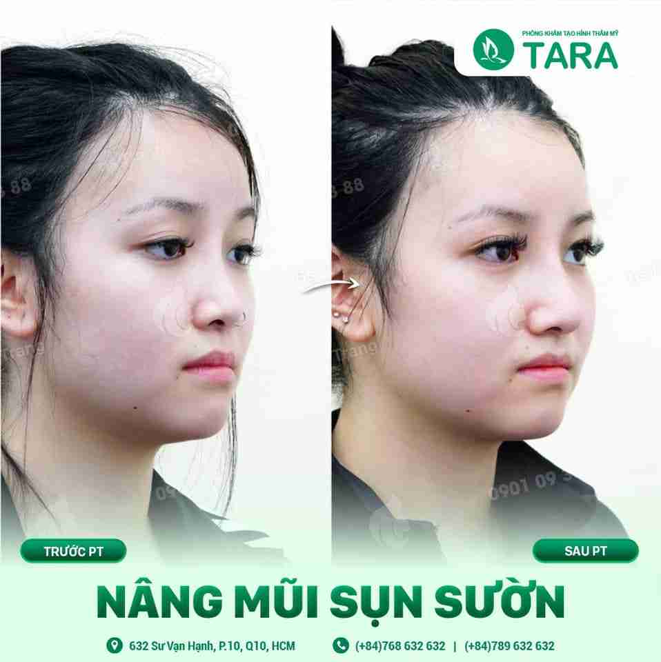 Những điều chưa biết về nâng mũi sụn sườn