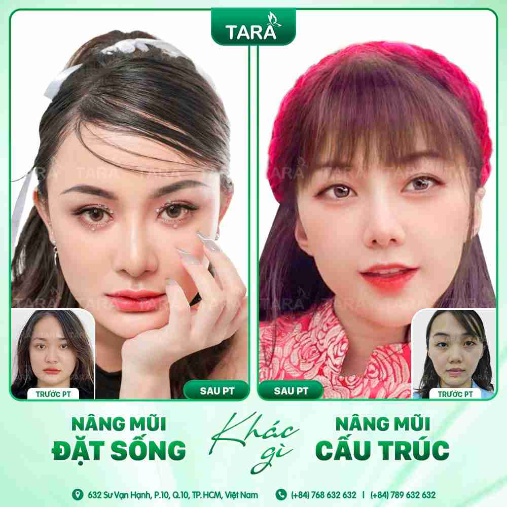 Sụn nhân tạo để nâng mũi