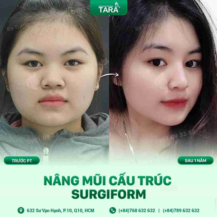Sụn nhân tạo để nâng mũi