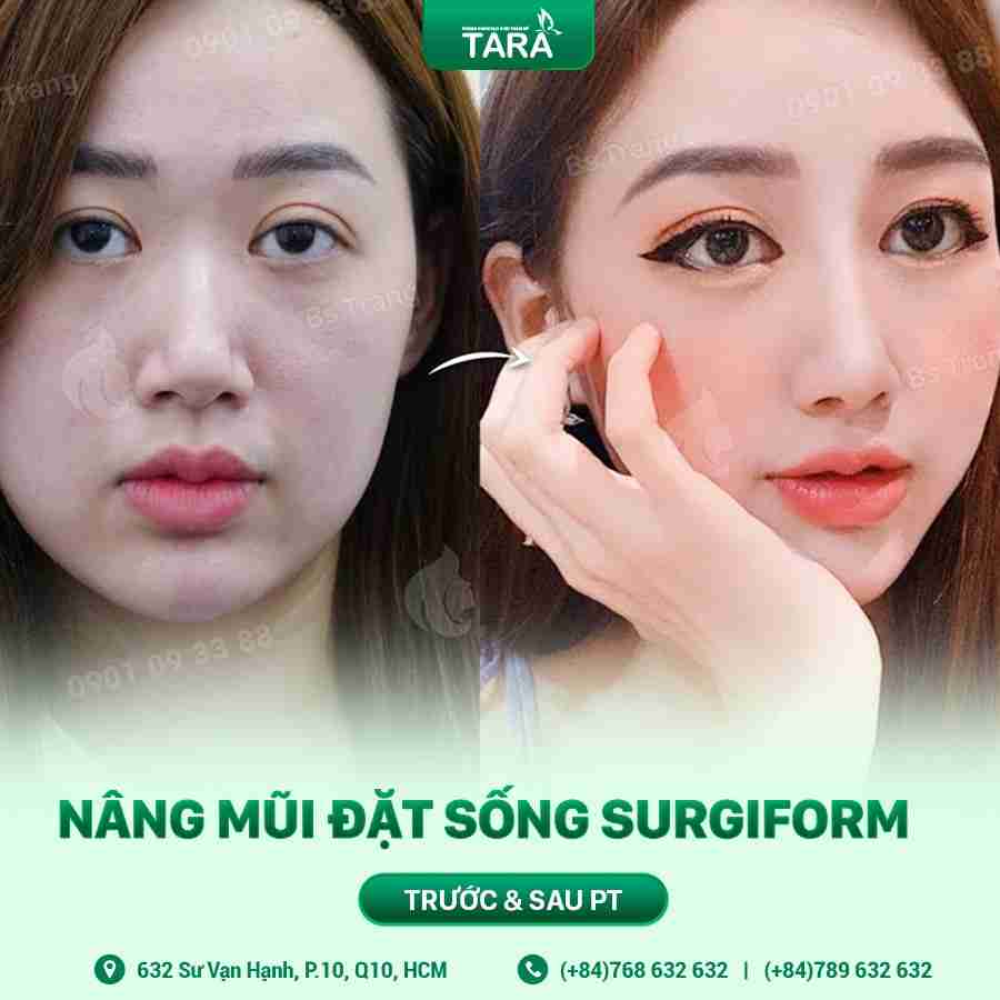 Sụn nhân tạo để nâng mũi