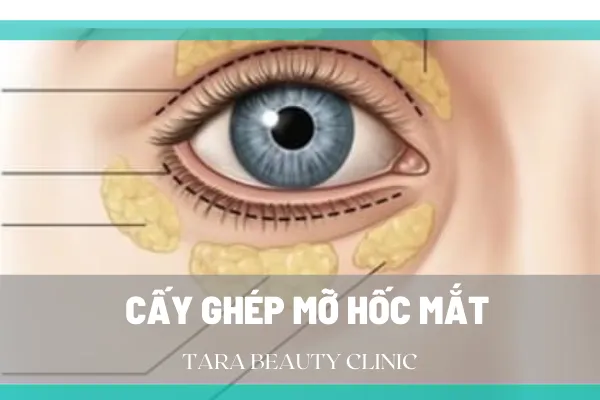 Tổng quan từ A-Z về phương pháp cấy mỡ hốc mắt