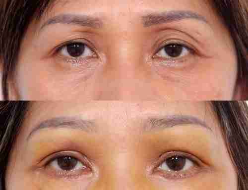 Tổng quan từ A-Z về phương pháp cấy mỡ hốc mắt