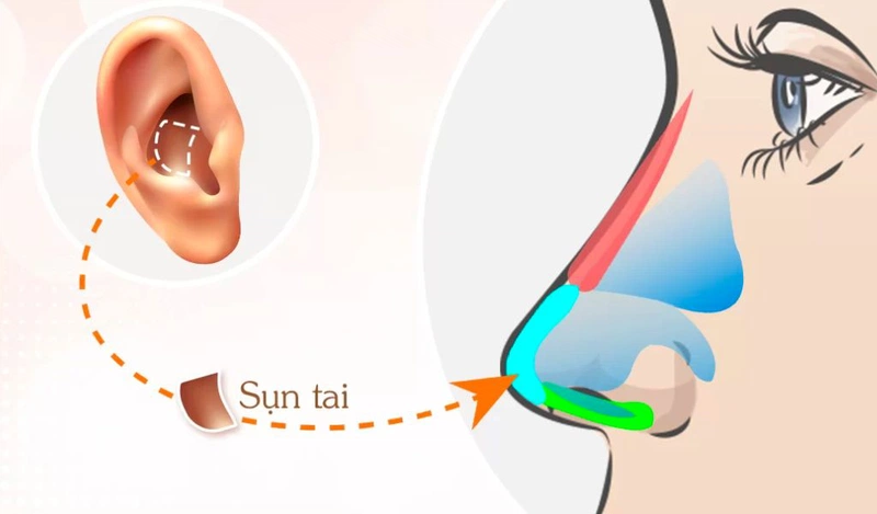 Tổng quan về phương pháp nâng mũi sụn tai