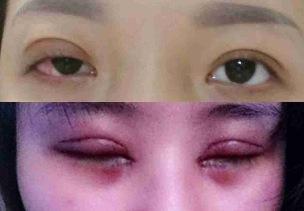 Bạn đã hiểu đúng về phương pháp cắt mí đôi chưa?