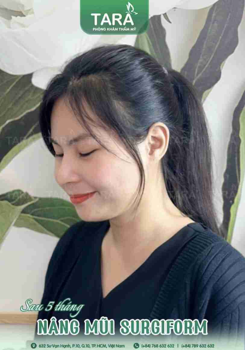 Tại sao phẫu thuật nâng mũi sụn Surgiform được ưa chuộng?