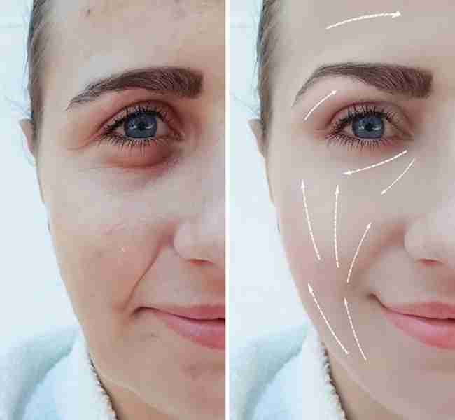 Những điều chưa biết về tiêm filler rãnh cười