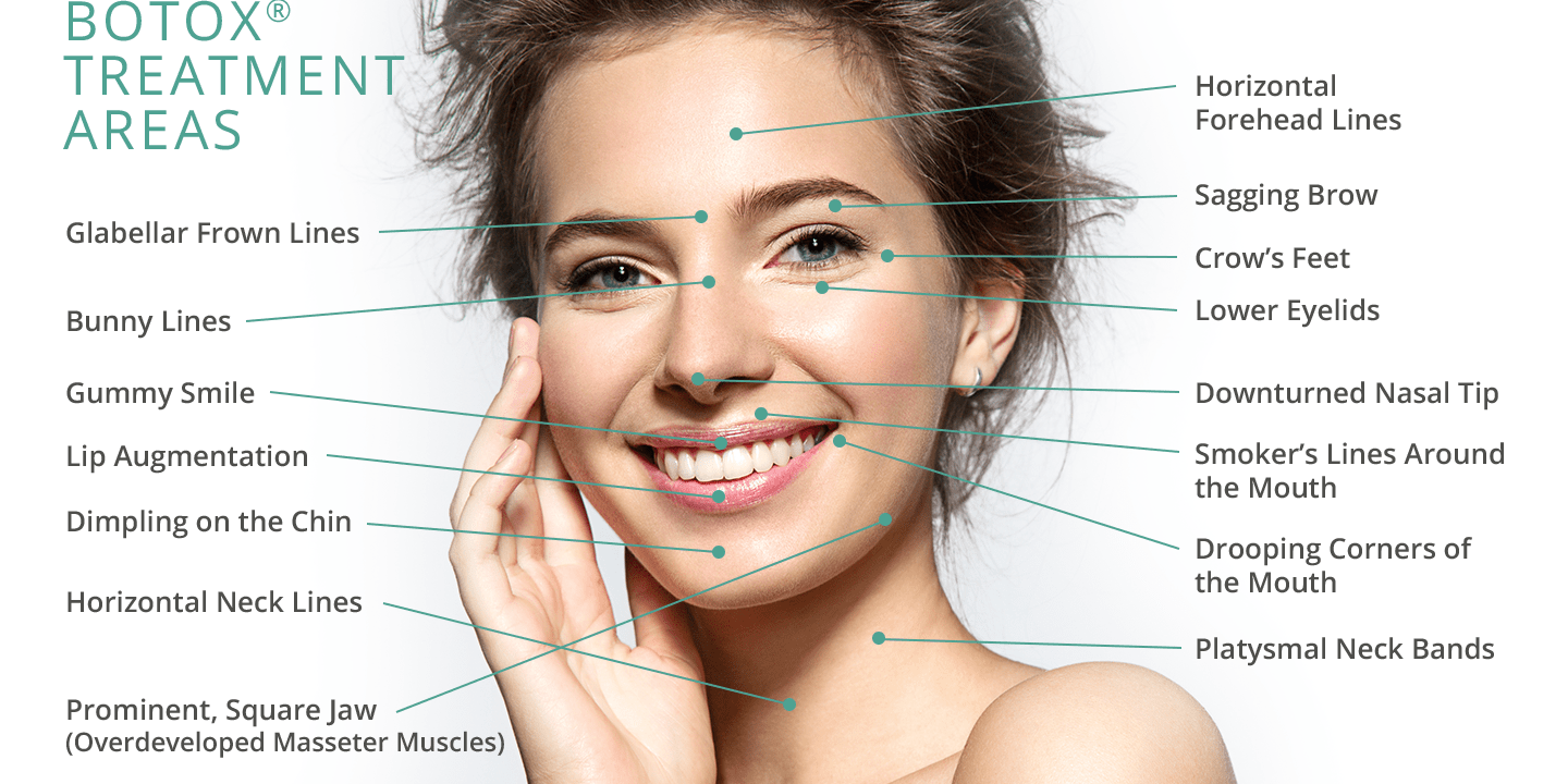 Tiêm botox là gì? Ưu nhược điểm và bảng giá