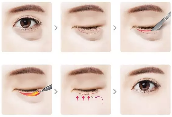 Lấy bọng mỡ mắt có bị lại không