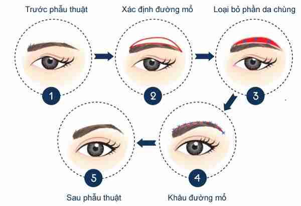 Mí sụp, nên nâng cung chân mày hay cắt mí thì tốt nhất?