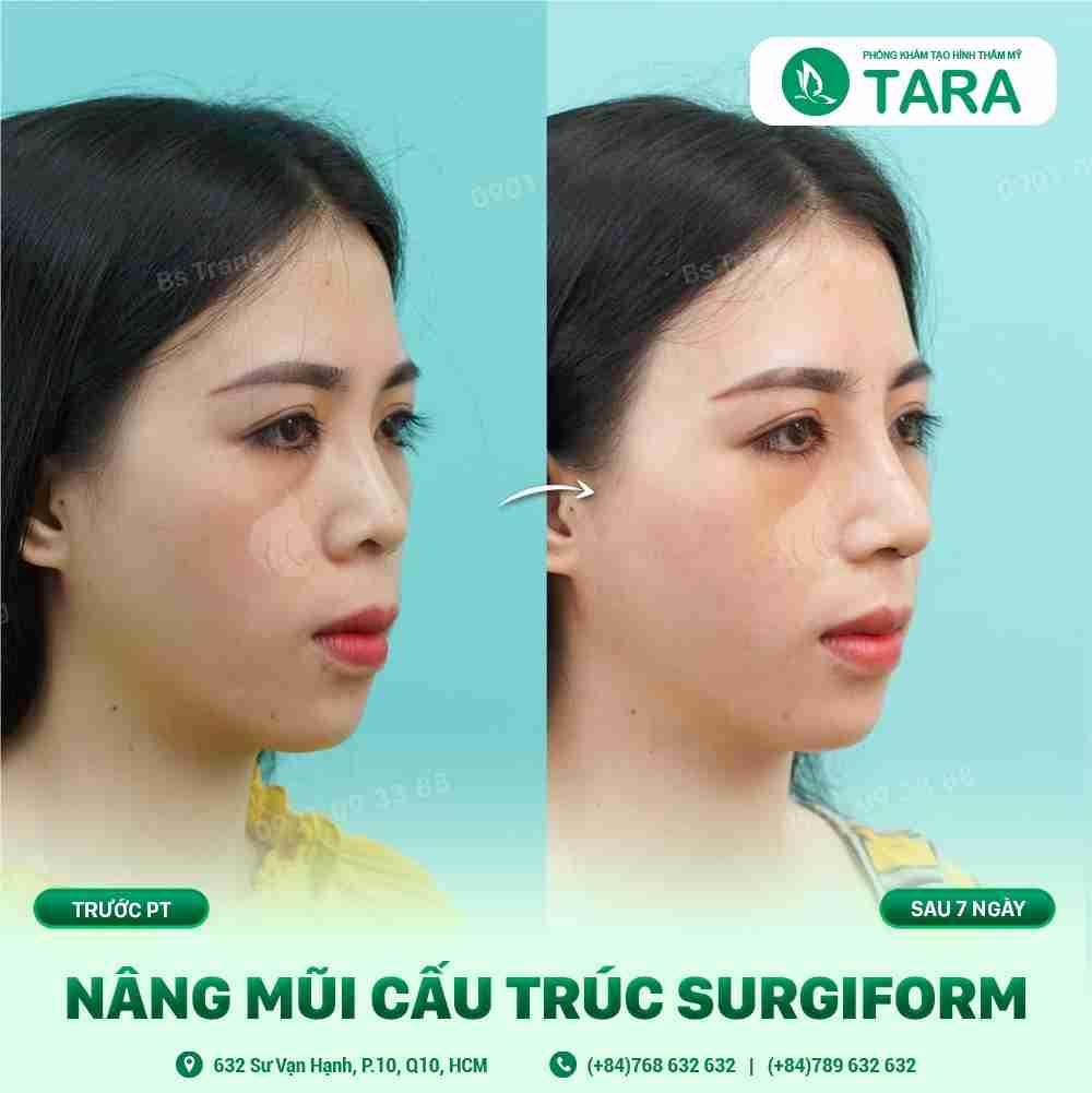 Nâng mũi sụn nhân tạo - Bí quyết sở hữu dáng mũi hoàn hảo
