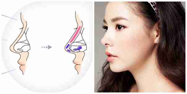 Nhiễm trùng sau nâng mũi nguy hiểm như thế nào?