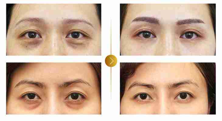 Tiêm filler bọng mắt là gì? Có nguy hiểm không?