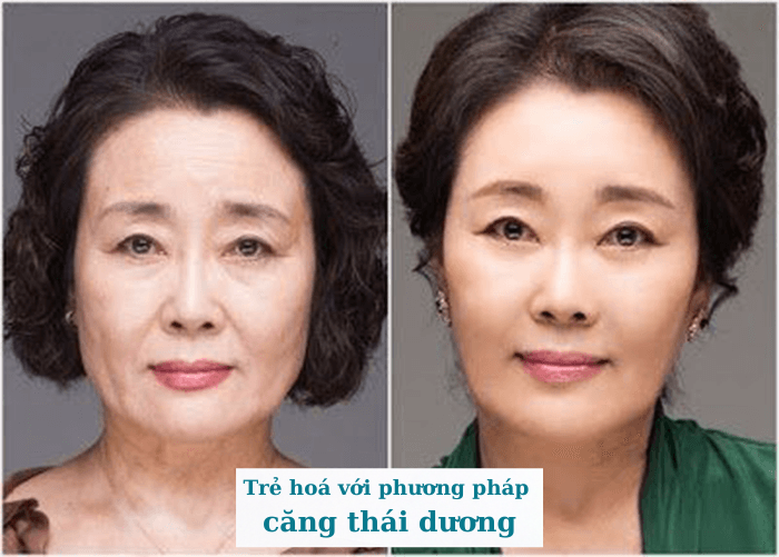 Căng da thái dương giá bao nhiêu?