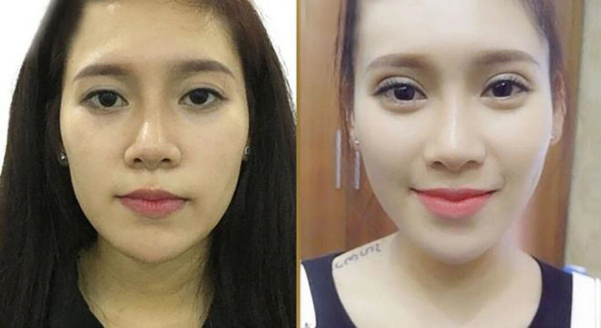 Hướng dẫn vệ sinh mắt đúng cách sau khi cắt mí mắt