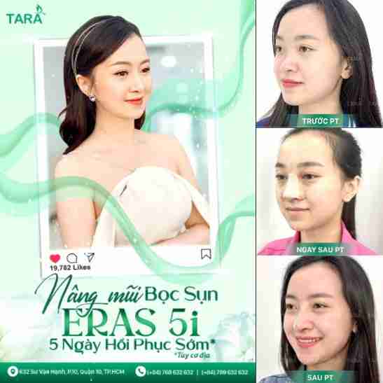 Công nghệ nâng mũi ERAS 5i hồi phục sớm