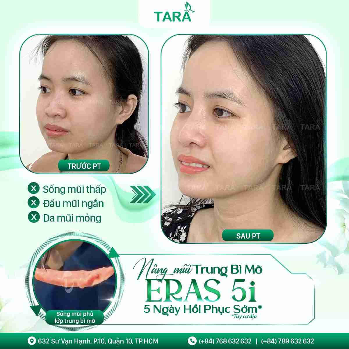 Nâng mũi ở đâu thì đẹp? Cách nhận biết cơ sở thẩm mỹ uy tín