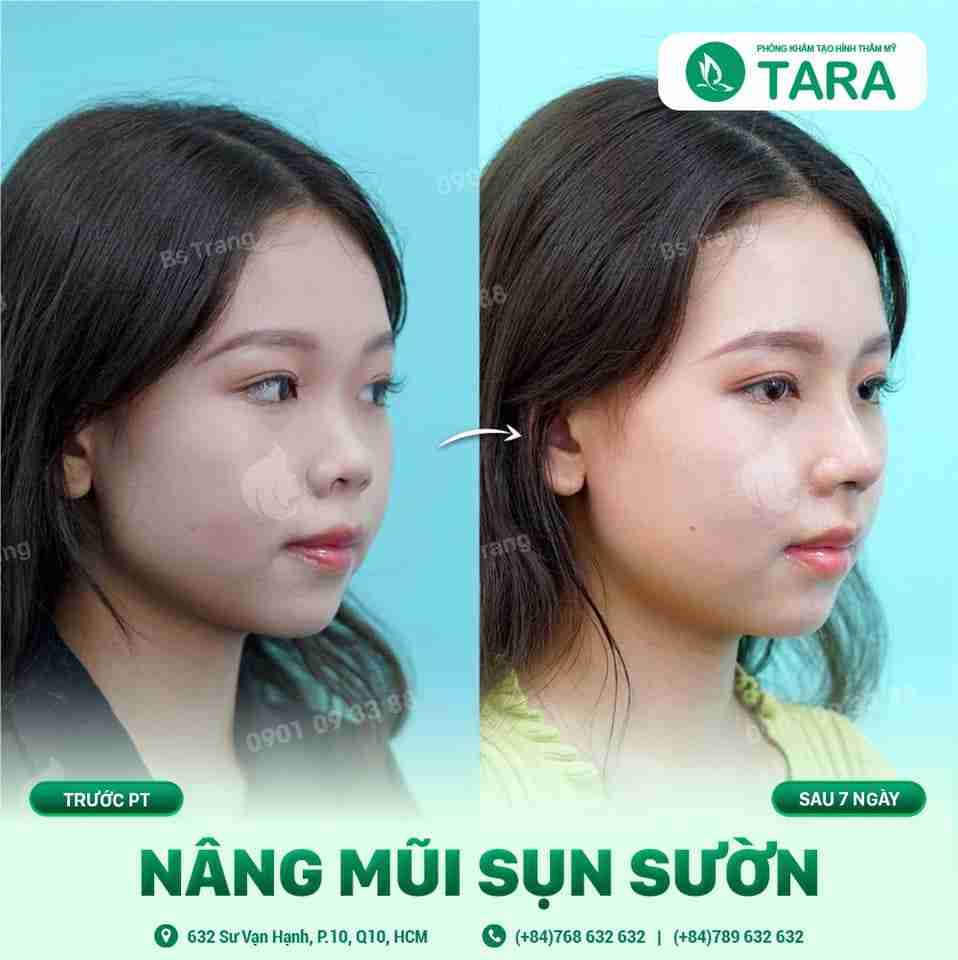 Nâng mũi ở đâu thì đẹp? Cách nhận biết cơ sở thẩm mỹ uy tín
