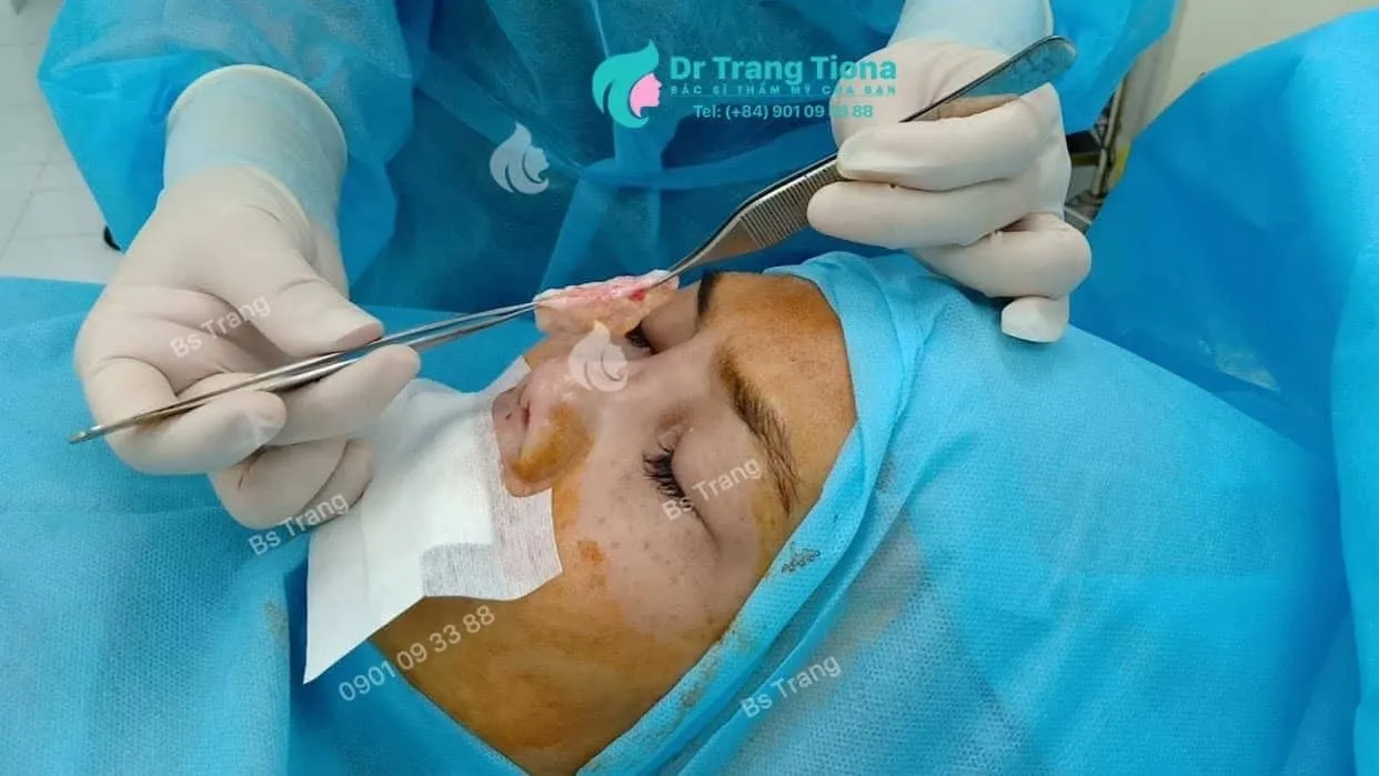 Nâng mũi trung bì mỡ ERAS 5i là gì?