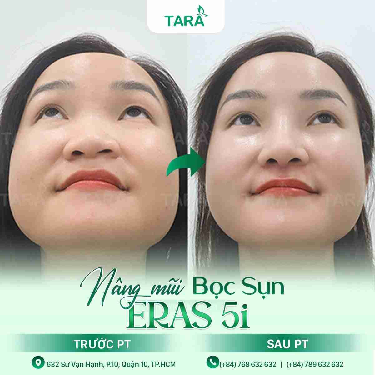 Nâng mũi bọc sụn ERAS 5i