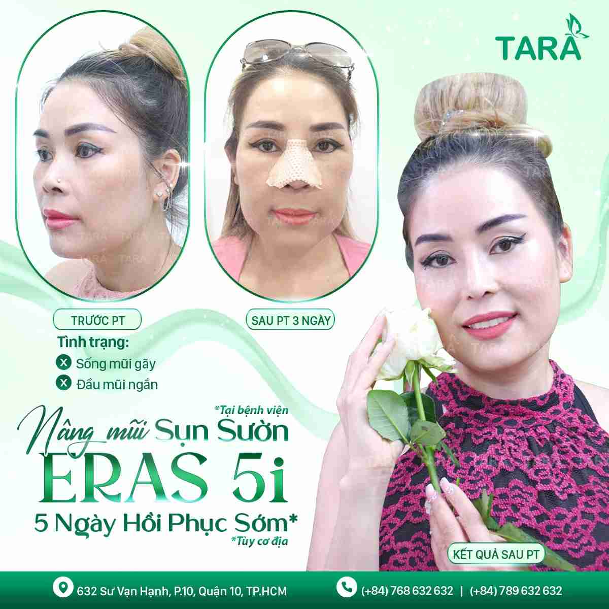 Nâng mũi bọc sụn ERAS 5i