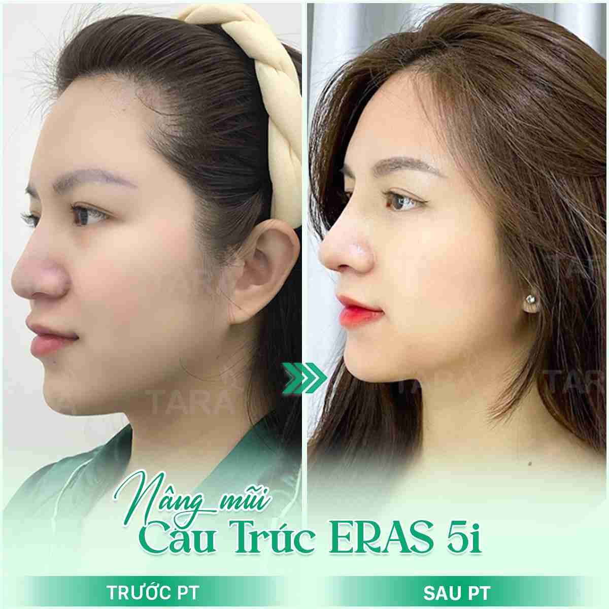 Nâng mũi cấu trúc ERAS 5i 