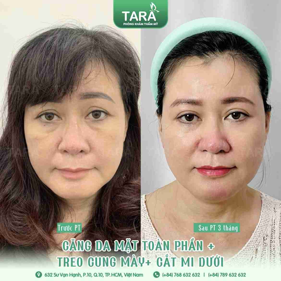 Bác sĩ giải đáp: Căng da mặt toàn phần gây mê hay gây tê?