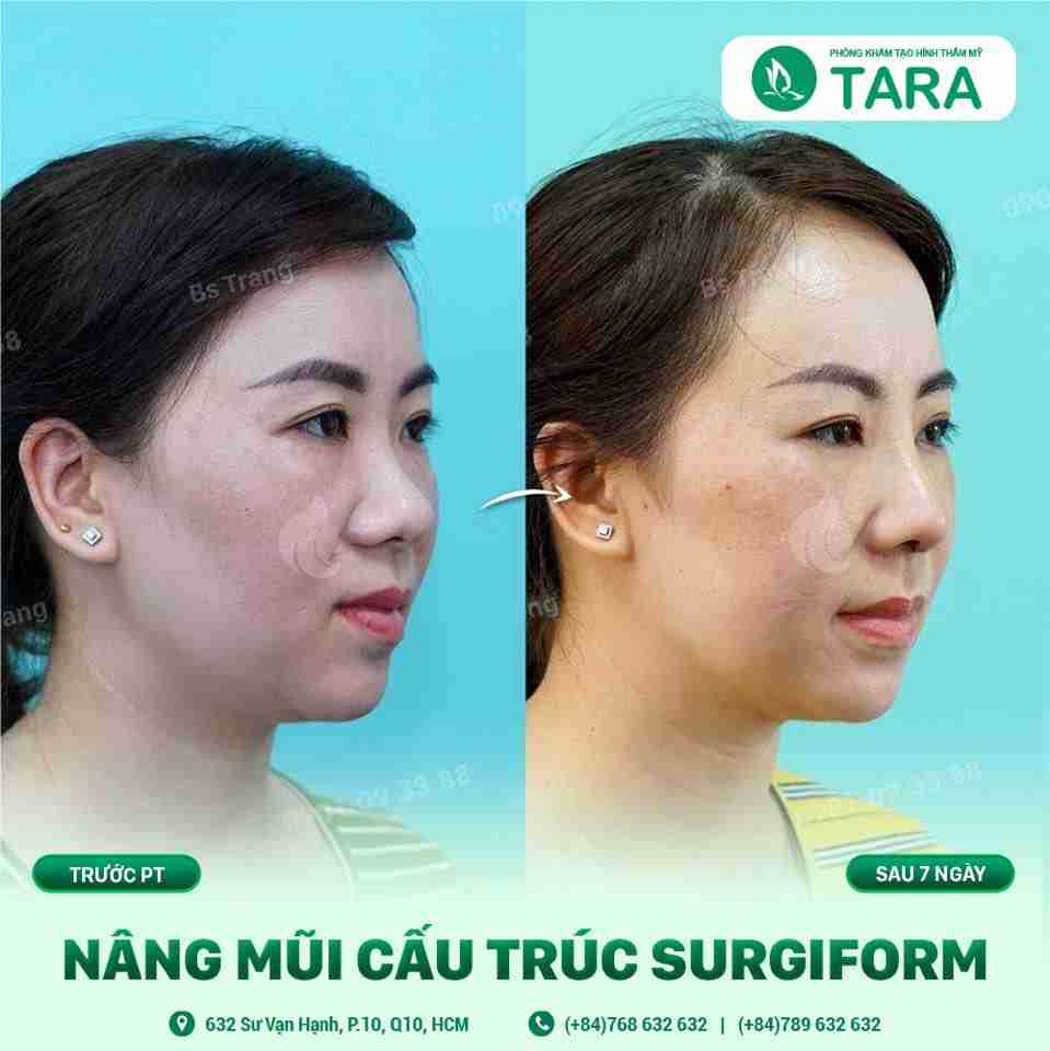 Cách hay nhất để xử lý đầu mũi bị hếch