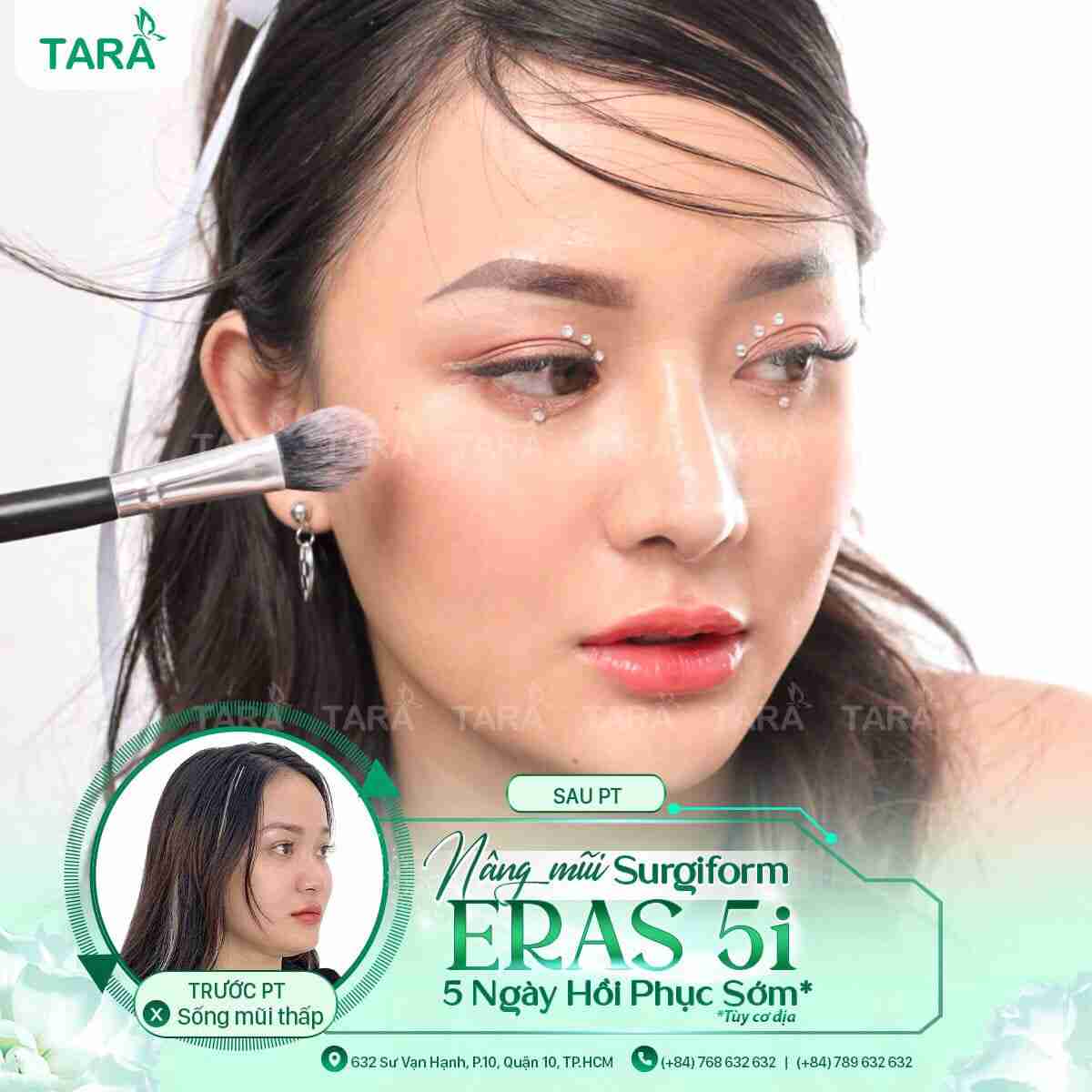 Nâng mũi ERAS 5i hồi phục sớm