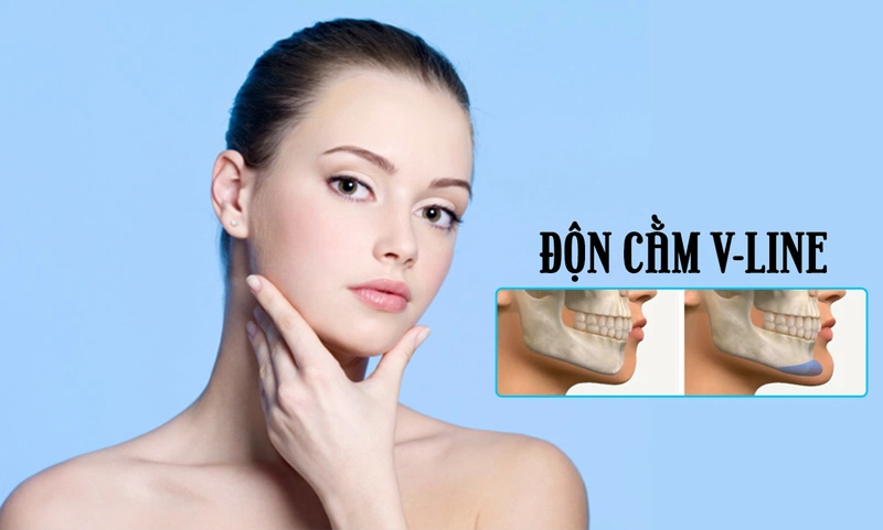 Sau khi độn cằm