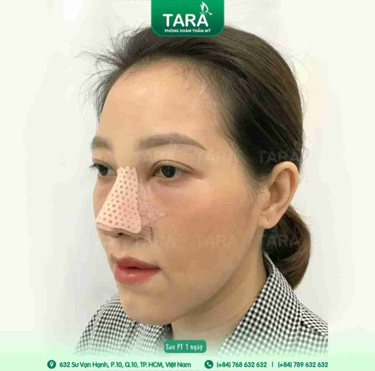 Nâng mũi ERAS 5i: 03 ngày tháo nẹp