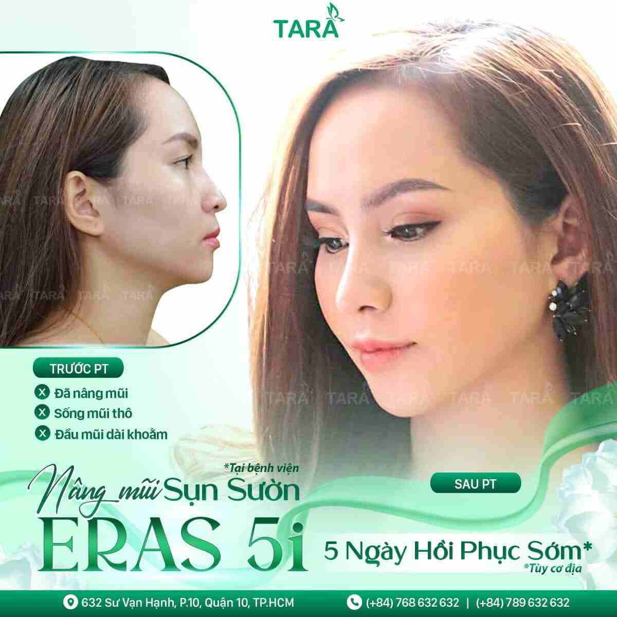 Nâng mũi bọc sụn ERAS 5i