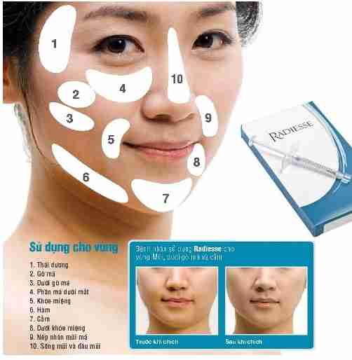 Tiêm Radiesse có tác dụng trẻ hóa như thế nào?