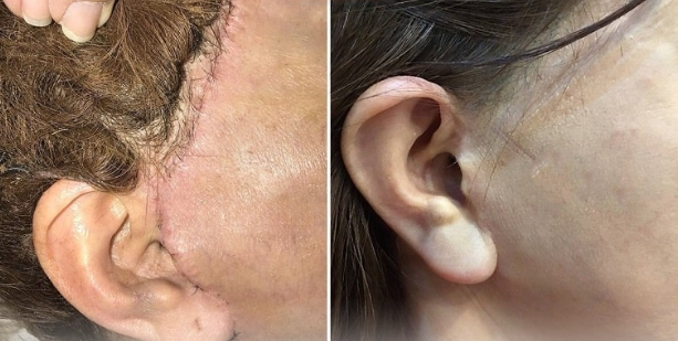 Cảnh báo biến chứng căng da mặt thái dương sai cách