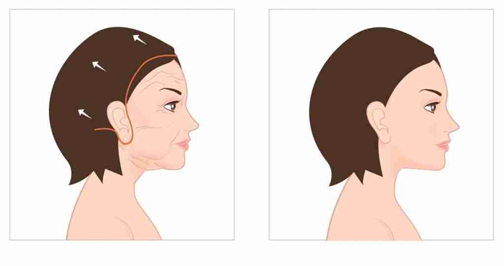 Cảnh báo biến chứng căng da mặt thái dương sai cách