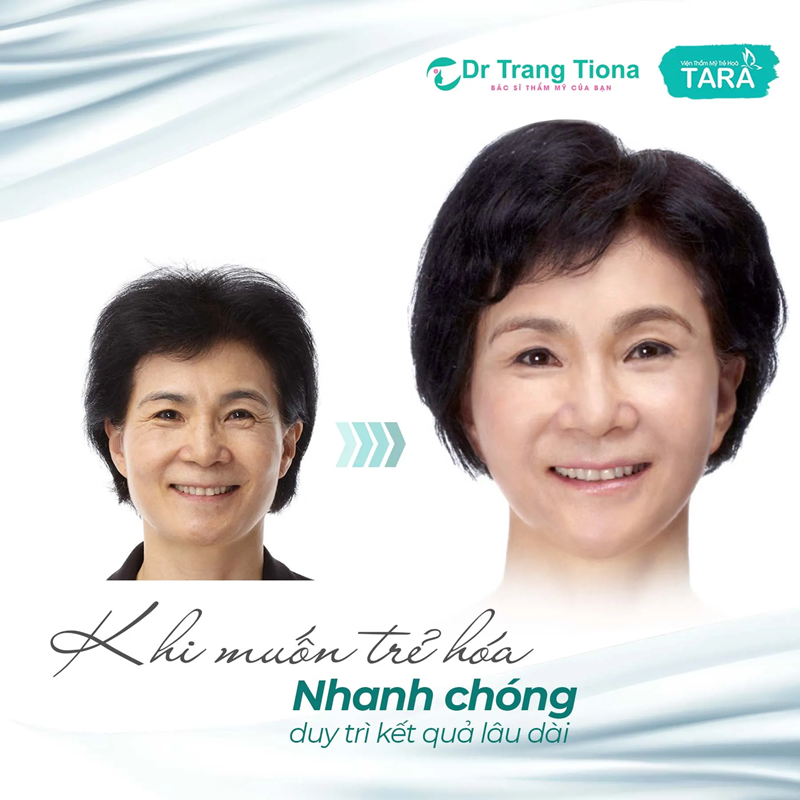  Khi nào nên phẫu thuật căng da mi dưới Midface