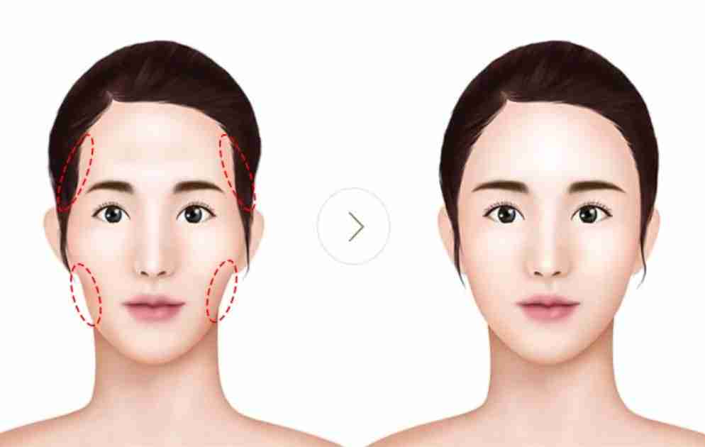 cấy mỡ mặt babyface