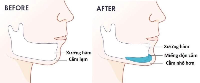 Độn cằm silicon được thực hiện như thế nào?